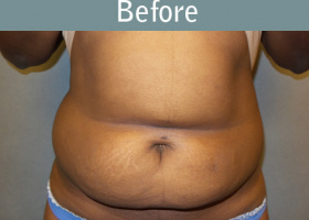 Milwaukee Plastic Surgery - Abdominoplasty - Tummy Tuck - 29-1