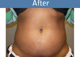 Milwaukee Plastic Surgery - Abdominoplasty - Tummy Tuck - 29-2