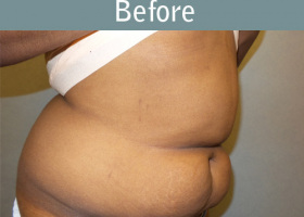 Milwaukee Plastic Surgery - Abdominoplasty - Tummy Tuck - 29-3