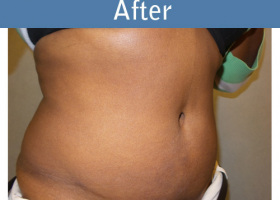 Milwaukee Plastic Surgery - Abdominoplasty - Tummy Tuck - 29-4