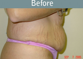 Milwaukee Plastic Surgery - Abdominoplasty - Tummy Tuck - 3-1