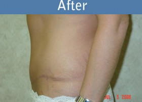 Milwaukee Plastic Surgery - Abdominoplasty - Tummy Tuck - 3-2