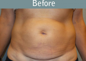 Milwaukee Plastic Surgery - Abdominoplasty - Tummy Tuck - 30-1