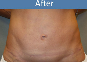 Milwaukee Plastic Surgery - Abdominoplasty - Tummy Tuck - 30-2