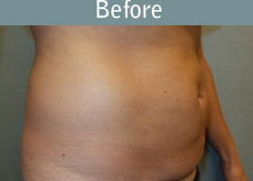 Milwaukee Plastic Surgery - Abdominoplasty - Tummy Tuck - 30-3