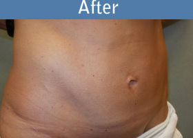 Milwaukee Plastic Surgery - Abdominoplasty - Tummy Tuck - 30-4