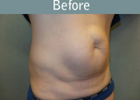 Milwaukee Plastic Surgery - Abdominoplasty - Tummy Tuck - 32-3