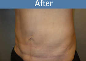 Milwaukee Plastic Surgery - Abdominoplasty - Tummy Tuck - 32-4