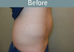 Milwaukee Plastic Surgery - Abdominoplasty - Tummy Tuck - 32-5