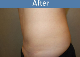 Milwaukee Plastic Surgery - Abdominoplasty - Tummy Tuck - 32-6