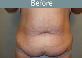 Milwaukee Plastic Surgery - Abdominoplasty - Tummy Tuck - 33-1