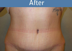 Milwaukee Plastic Surgery - Abdominoplasty - Tummy Tuck - 33-2