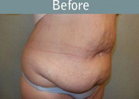 Milwaukee Plastic Surgery - Abdominoplasty - Tummy Tuck - 33-3