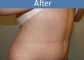 Milwaukee Plastic Surgery - Abdominoplasty - Tummy Tuck - 33-4