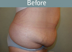 Milwaukee Plastic Surgery - Abdominoplasty - Tummy Tuck - 33-5