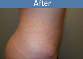Milwaukee Plastic Surgery - Abdominoplasty - Tummy Tuck - 33-6