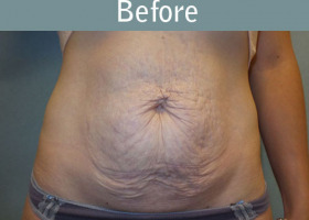 Milwaukee Plastic Surgery - Abdominoplasty - Tummy Tuck - 34-1