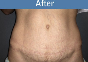 Milwaukee Plastic Surgery - Abdominoplasty - Tummy Tuck - 34-2
