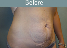 Milwaukee Plastic Surgery - Abdominoplasty - Tummy Tuck - 34-3