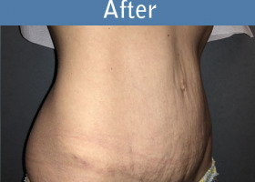 Milwaukee Plastic Surgery - Abdominoplasty - Tummy Tuck - 34-4
