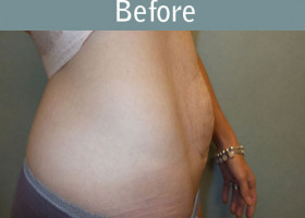 Milwaukee Plastic Surgery - Abdominoplasty - Tummy Tuck - 34-5
