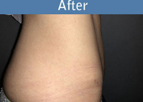 Milwaukee Plastic Surgery - Abdominoplasty - Tummy Tuck - 34-6