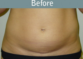 Milwaukee Plastic Surgery - Abdominoplasty - Tummy Tuck - 7-1