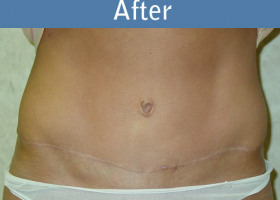 Milwaukee Plastic Surgery - Abdominoplasty - Tummy Tuck - 7-2