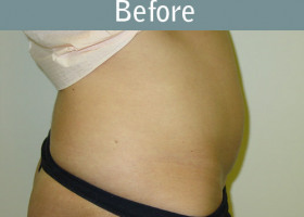 Milwaukee Plastic Surgery - Abdominoplasty - Tummy Tuck - 8-1