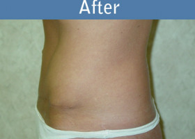 Milwaukee Plastic Surgery - Abdominoplasty - Tummy Tuck - 8-2