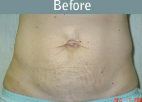 Milwaukee Plastic Surgery - Abdominoplasty - Tummy Tuck - 9-1