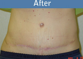 Milwaukee Plastic Surgery - Abdominoplasty - Tummy Tuck - 9-2