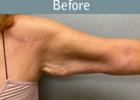 Milwaukee Plastic Surgery - Arm Lift - 3-3