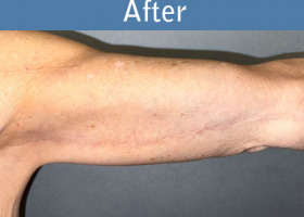 Milwaukee Plastic Surgery - Arm Lift - 3-4