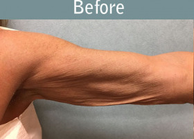 Milwaukee Plastic Surgery - Arm Lift - 3-3