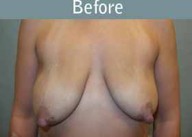 Milwaukee Plastic Surgery - Augmentation With Breast Lift - 1-1