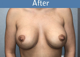Milwaukee Plastic Surgery - Augmentation With Breast Lift - 1-2