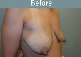Milwaukee Plastic Surgery - Augmentation With Breast Lift - 1-3