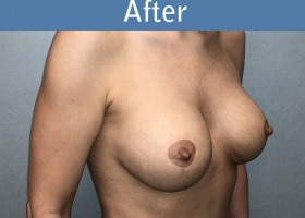 Milwaukee Plastic Surgery - Augmentation With Breast Lift - 1-4