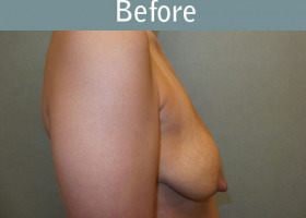 Milwaukee Plastic Surgery - Augmentation With Breast Lift - 1-5