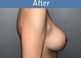 Milwaukee Plastic Surgery - Augmentation With Breast Lift - 1-6