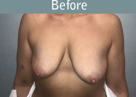 Milwaukee Plastic Surgery - Augmentation With Breast Lift - 2-1