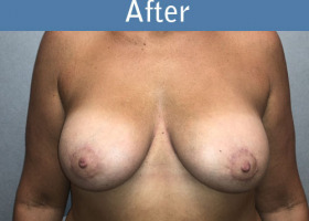 Milwaukee Plastic Surgery - Augmentation With Breast Lift - 2-2