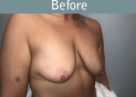 Milwaukee Plastic Surgery - Augmentation With Breast Lift - 2-3