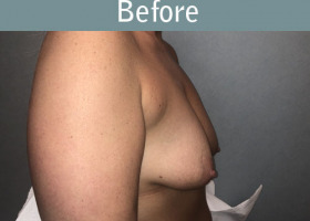 Milwaukee Plastic Surgery - Augmentation With Breast Lift - 2-5