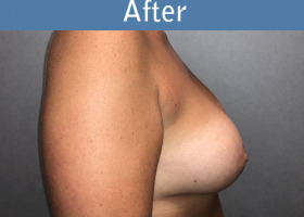 Milwaukee Plastic Surgery - Augmentation With Breast Lift - 2-6