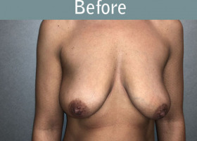 Milwaukee Plastic Surgery - Augmentation With Breast Lift - 3-1