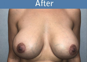 Milwaukee Plastic Surgery - Augmentation With Breast Lift - 3-2