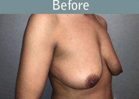 Milwaukee Plastic Surgery - Augmentation With Breast Lift - 3-3