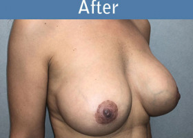 Milwaukee Plastic Surgery - Augmentation With Breast Lift - 3-4
